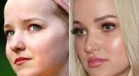 Does Dove Cameron Done Lip & Botox Surgery? Fans Suspect Lip Filler And Cheekbone Uplift