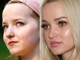 Does Dove Cameron Done Lip & Botox Surgery? Fans Suspect Lip Filler And Cheekbone Uplift