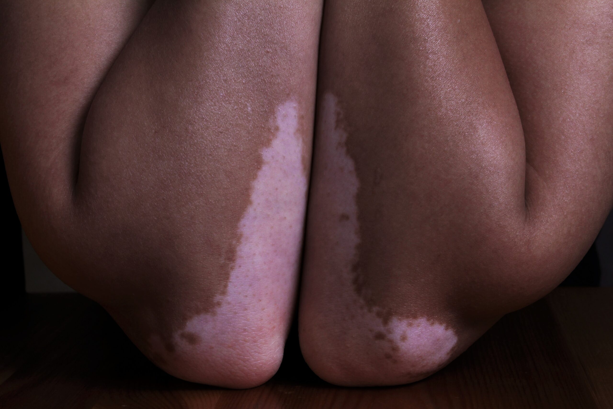 How To Detect Vitiligo? Signs People Should Look Out For & Types, Treatment And Prevention