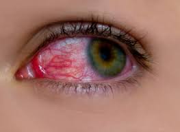 Best Tip To Follow For Prevention: Monsoon Season Eye Infections