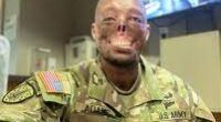 Before and After Randy Adams Accident Face: How Did It Happen To The Soldier Injury and Burns