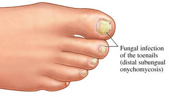 What Are 3 Signs of A Fungal Nail Infection? Cause And Treatments
