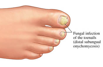 What Are 3 Signs of A Fungal Nail Infection? Cause And Treatments