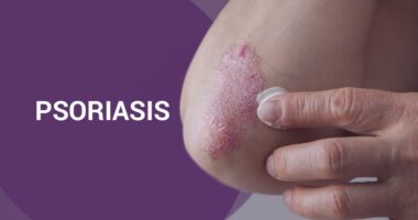What Is the Best Treatment for Psoriasis? Pictures, Symptoms, Causes, and Diagnosis
