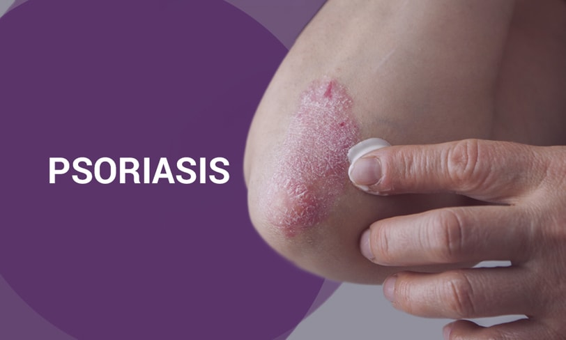What Is the Best Treatment for Psoriasis? Pictures, Symptoms, Causes, and Diagnosis