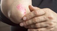 How do you tell the difference between eczema and skin cancer?