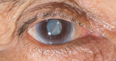 How To Prevent Cataracts As You Age