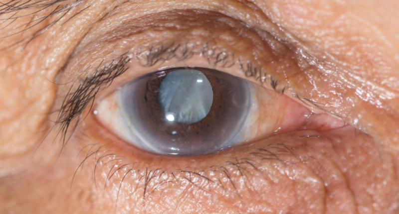 How To Prevent Cataracts As You Age