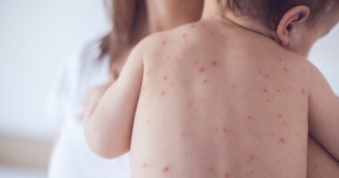 How To Protect Your Baby From Measles