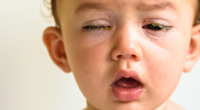 Eye Flu Cases Rising in Schools: 7 Tips to Protect Children from Conjunctivitis