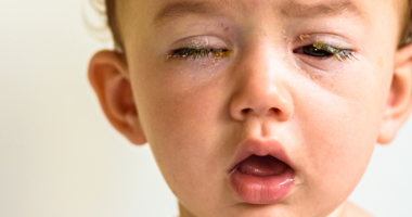 Eye Flu Cases Rising in Schools: 7 Tips to Protect Children from Conjunctivitis