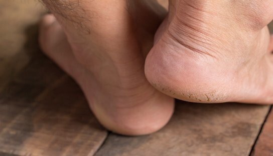 5 Home Remedies To Fix Cracked Heels Instantly