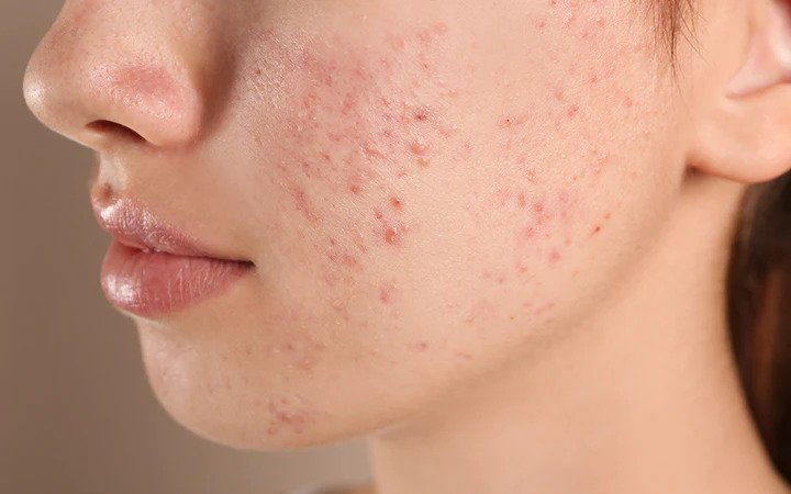 6 Acne-Causing Foods That You Must Avoid For Clear Skin