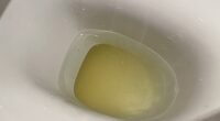 What Does It Mean If Your Urine Is Cloudy?