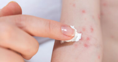Contact Dermatitis Rash: This is Why You Frequently Have Rash