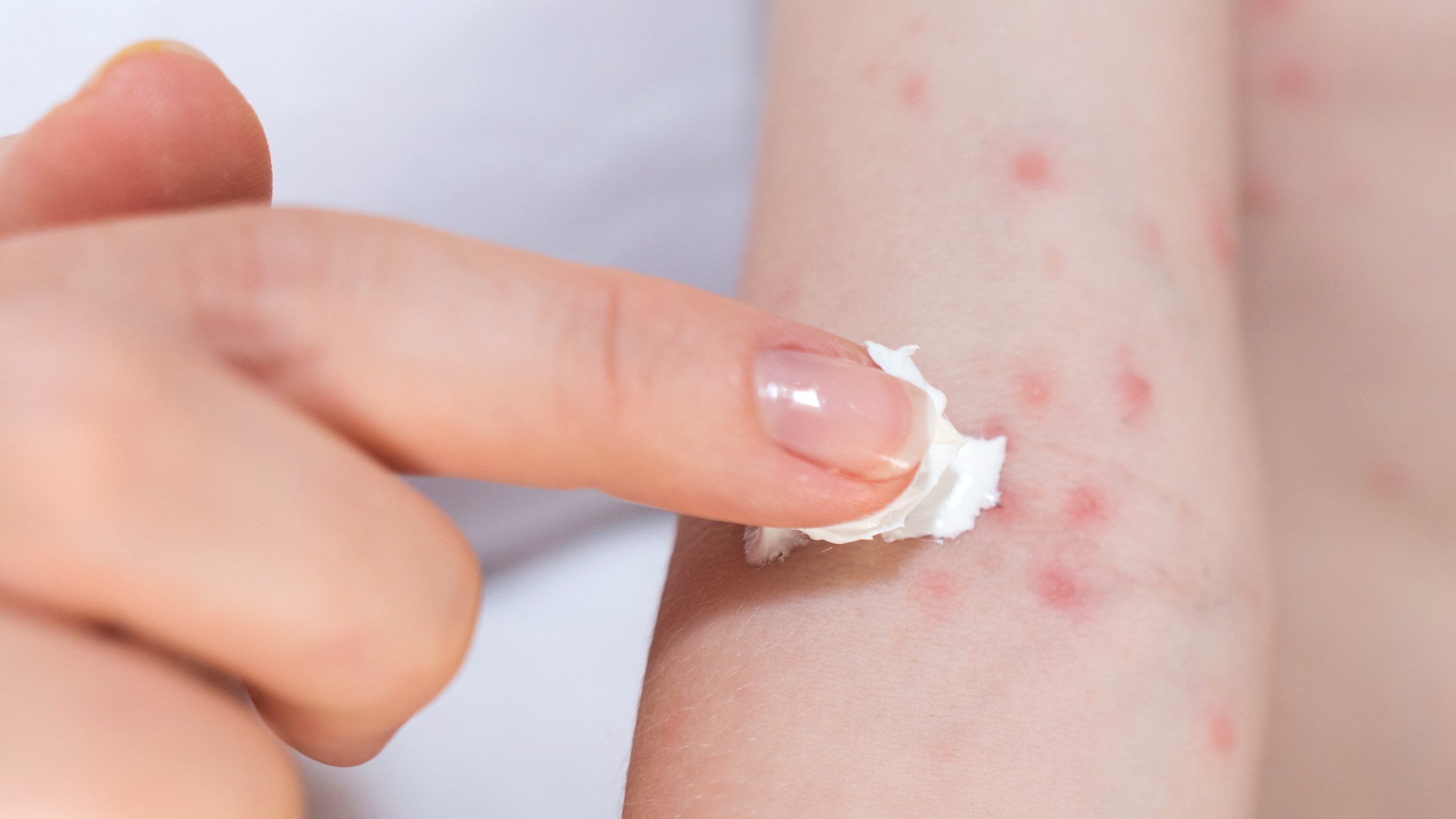 Contact Dermatitis Rash: This is Why You Frequently Have Rash