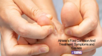 Athlete’s Foot Condition And Treatment: Symptoms and Causes