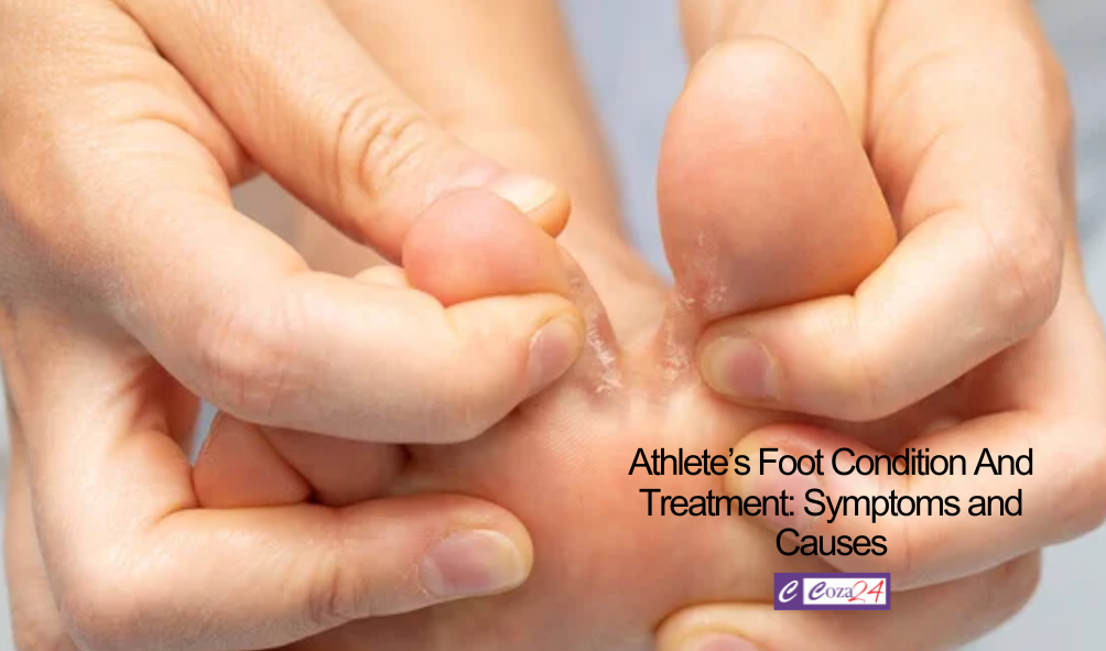 Athlete’s Foot Condition And Treatment: Symptoms and Causes