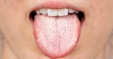 Effective Home Remedies for White Tongue and Bad Breath