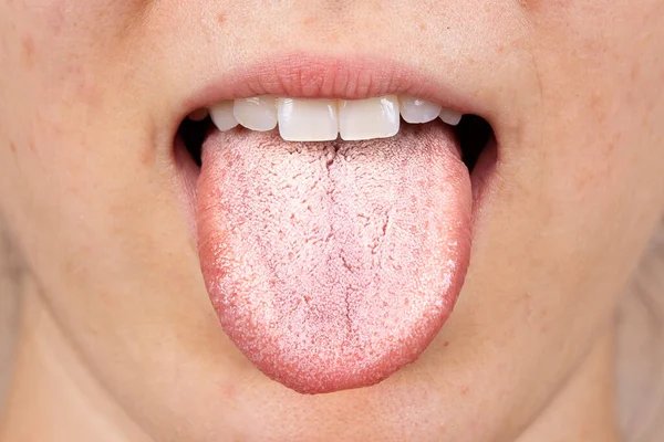 Effective Home Remedies for White Tongue and Bad Breath