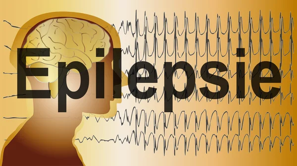 Understanding Epilepsy in Babies Under 1 Year Old: Causes, Symptoms, Diagnosis and Treatment