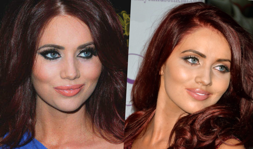Has Amy Childs Get Plastic Surgery Done?