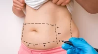 How To Prepare For Liposuction Surgery? Dos and Don'ts