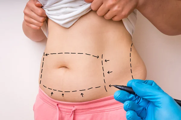 How To Prepare For Liposuction Surgery? Dos and Don'ts