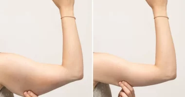 Is Arm Lift Better Than Arm Liposuction: Which Procedure Is Best For Me?