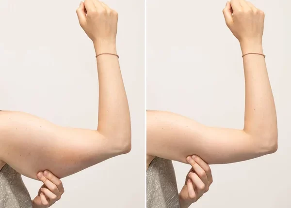Is Arm Lift Better Than Arm Liposuction: Which Procedure Is Best For Me?