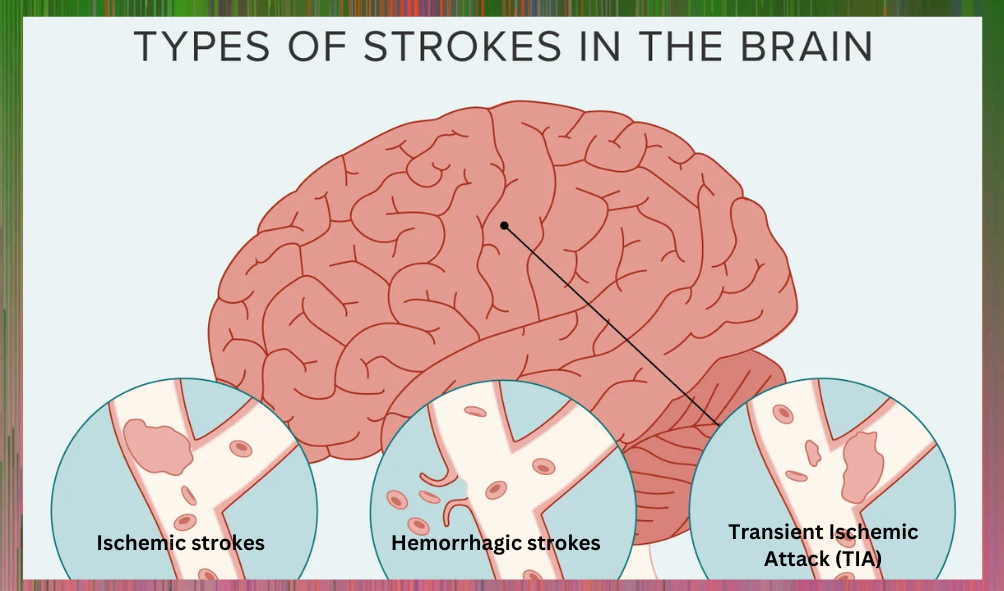 Types of Stroke And Treatment: What You Need To Know And Signs