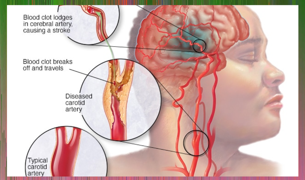 Types of Stroke And Treatment