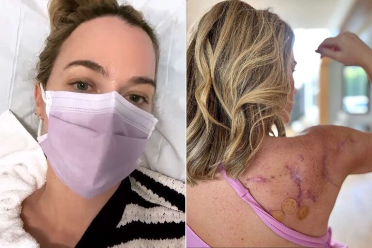 Teddi Mellencamp Shares Surgery Scar to Raise Skin Cancer Awareness